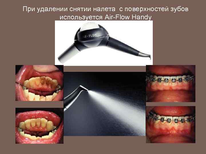 При удалении снятии налета с поверхностей зубов используется Air-Flow Handy 