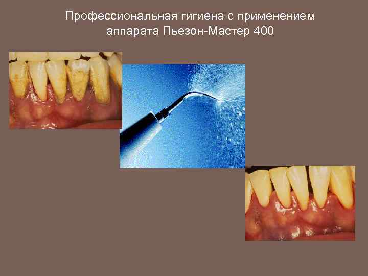 Профессиональная гигиена с применением аппарата Пьезон-Мастер 400 