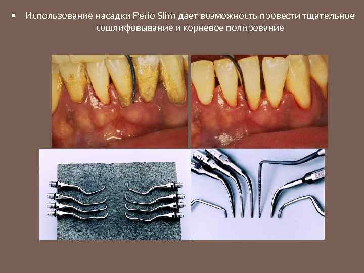  Использование насадки Perio Slim дает возможность провести тщательное сошлифовывание и корневое полирование 