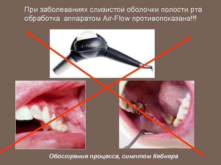 При заболеваниях слизистой оболочки полости рта обработка аппаратом Air-Flow противопоказана!!! Обострение процесса, симптом Кебнера