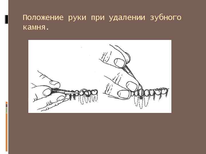 Положение свободных. Положение рук при удалении зуба. Положение левой руки при удалении зуба. Положение руки при удалении зубов. Удаление зубов презентация.