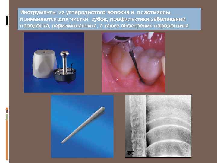Инструменты из углеродистого волокна и пластмассы применяются для чистки зубов, профилактики заболеваний пародонта, периимплантита,