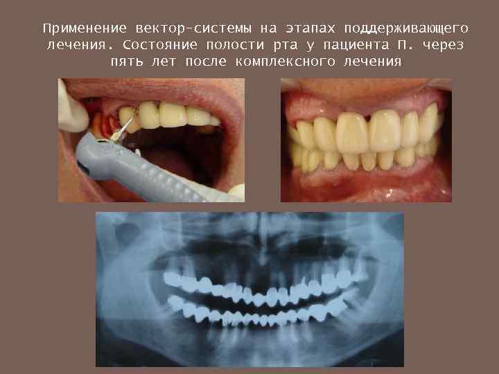 Применение вектор-системы на этапах поддерживающего лечения. Состояние полости рта у пациента П. через пять