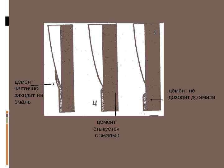 цемент частично заходит на эмаль цемент не доходит до эмали цемент стыкуется с эмалью