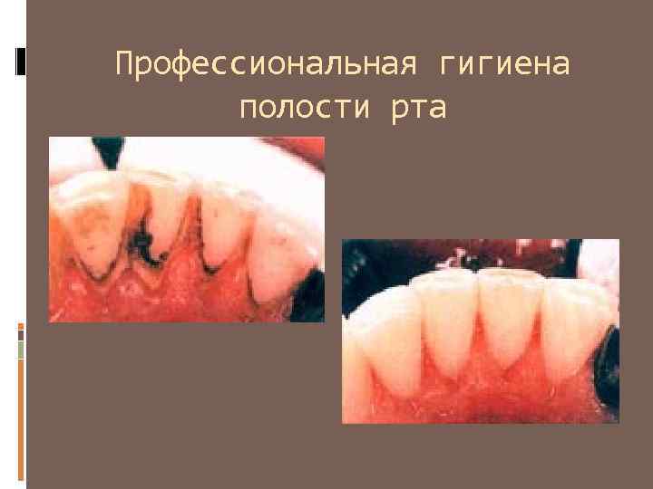 МИСВАК ДЛЯ ЧИСТКИ ЗУБОВ зубная бляшка наддесневая