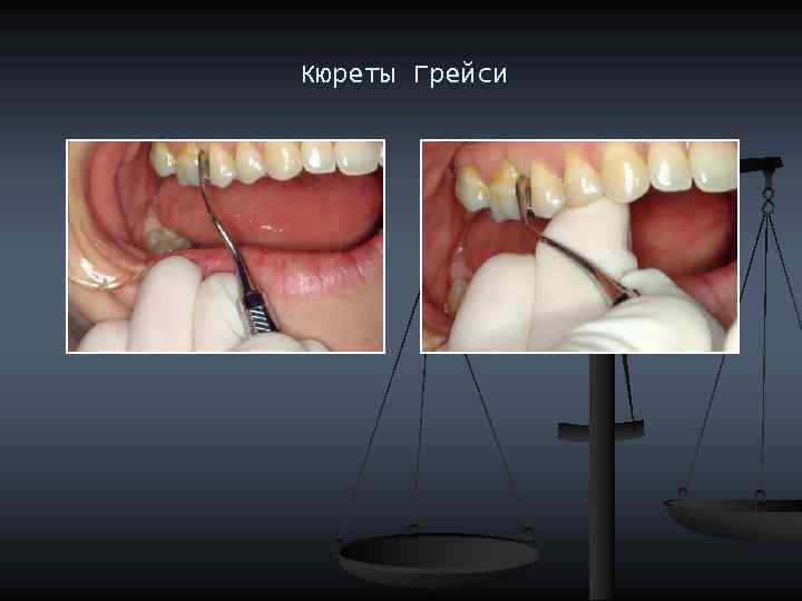 Кюреты Грейси 