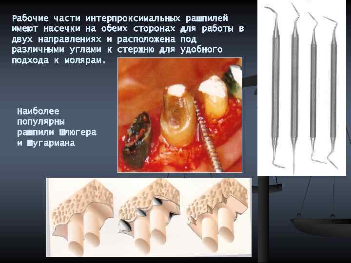 Рабочие части интерпроксимальных рашпилей имеют насечки на обеих сторонах для работы в двух направлениях