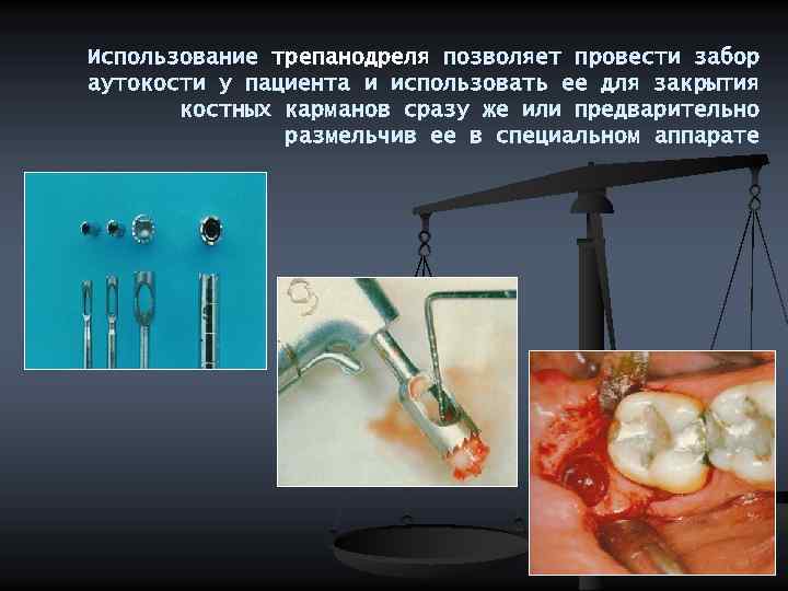 Использование трепанодреля позволяет провести забор аутокости у пациента и использовать ее для закрытия костных