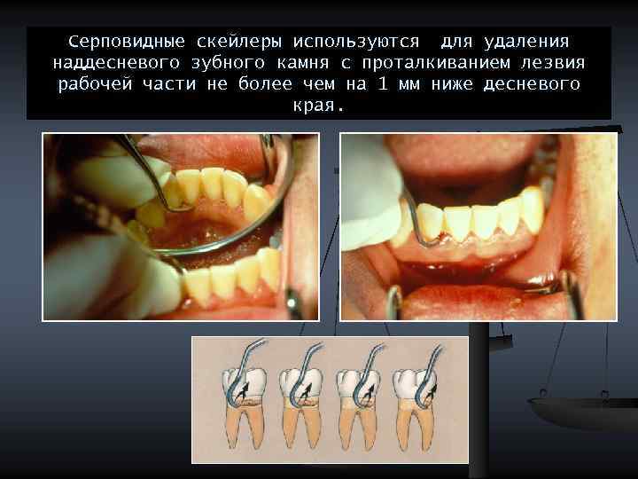 Серповидные скейлеры используются для удаления наддесневого зубного камня с проталкиванием лезвия рабочей части не