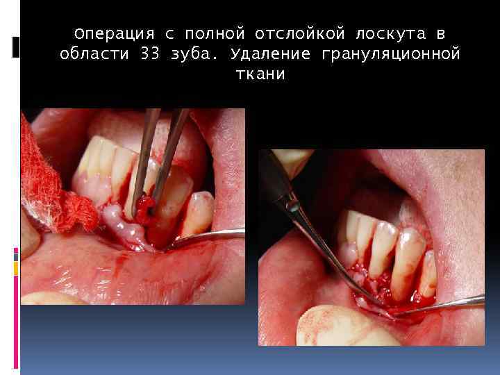Операция с полной отслойкой лоскута в области 33 зуба. Удаление грануляционной ткани 