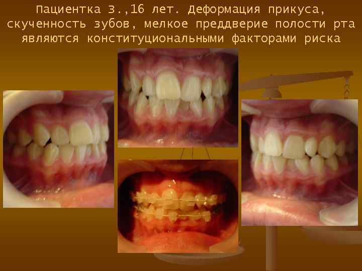 Пациентка З. , 16 лет. Деформация прикуса, скученность зубов, мелкое преддверие полости рта являются