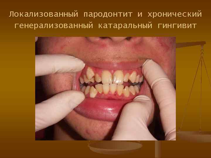 Локализованный пародонтит и хронический генерализованный катаральный гингивит 