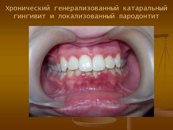 Хронический генерализованный катаральный гингивит и локализованный пародонтит 