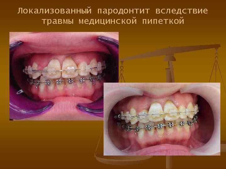 Локализованный пародонтит вследствие травмы медицинской пипеткой 