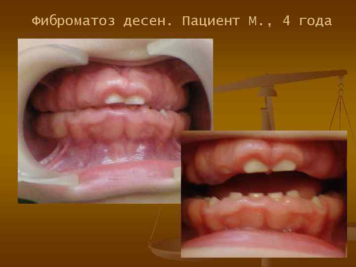 Фиброматоз десен. Пациент М. , 4 года 