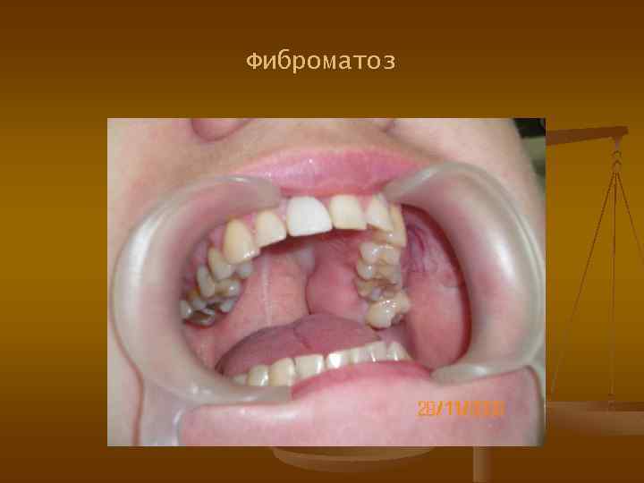 Фиброматоз 