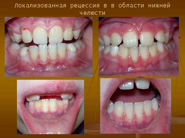 Локализованная рецессия в в области нижней челюсти 