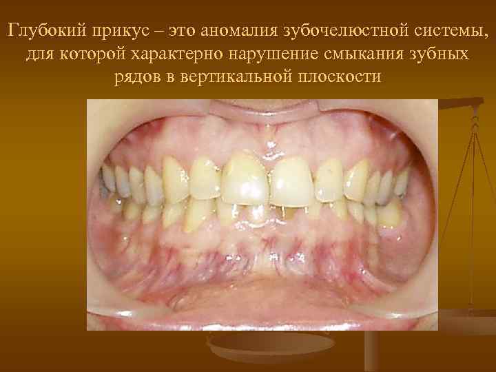 Глубокий прикус – это аномалия зубочелюстной системы, для которой характерно нарушение смыкания зубных рядов