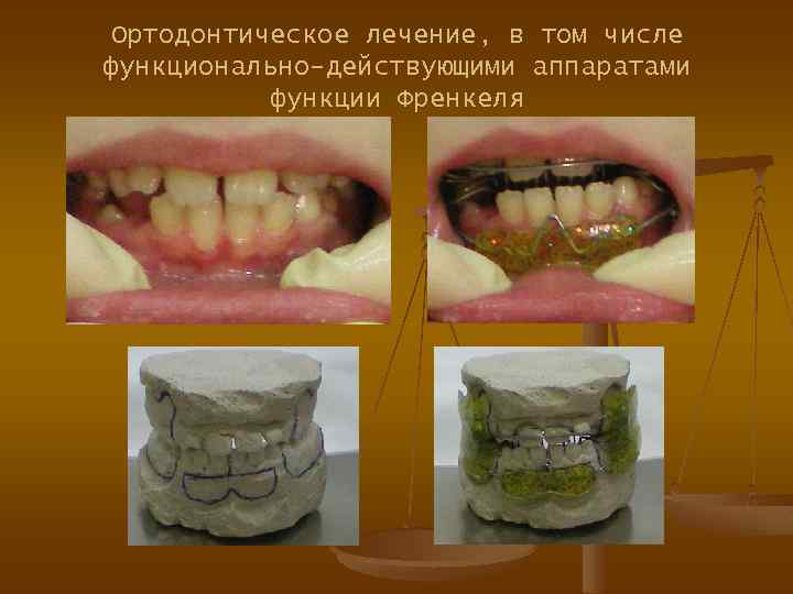 Ортодонтическое лечение, в том числе функционально-действующими аппаратами функции Френкеля 