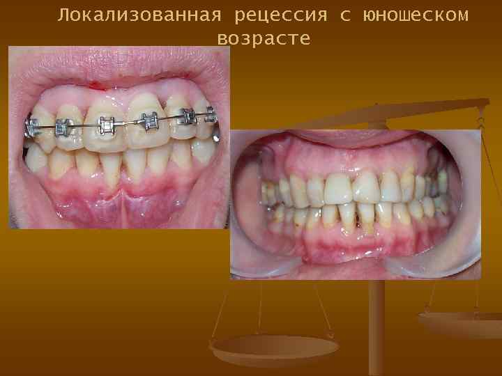 Локализованная рецессия с юношеском возрасте 