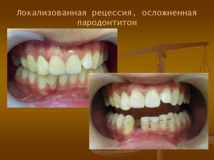 Локализованная рецессия, осложненная пародонтитом 