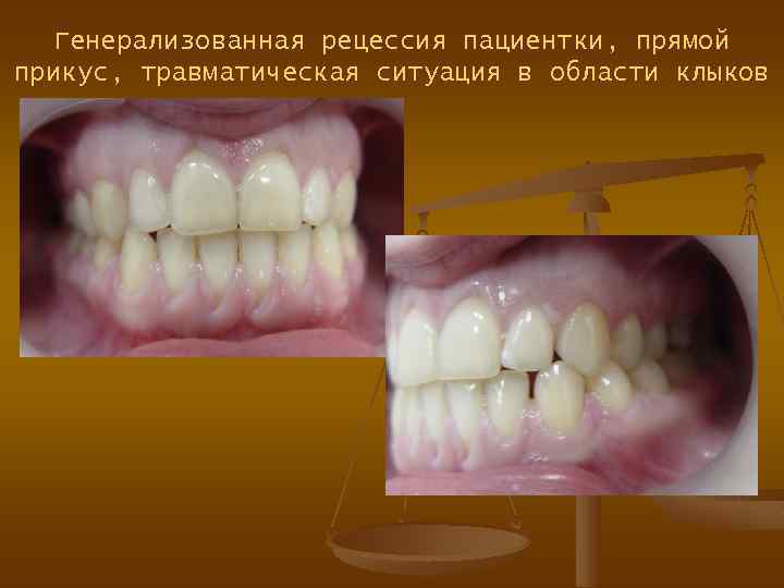 Генерализованная рецессия пациентки, прямой прикус, травматическая ситуация в области клыков 