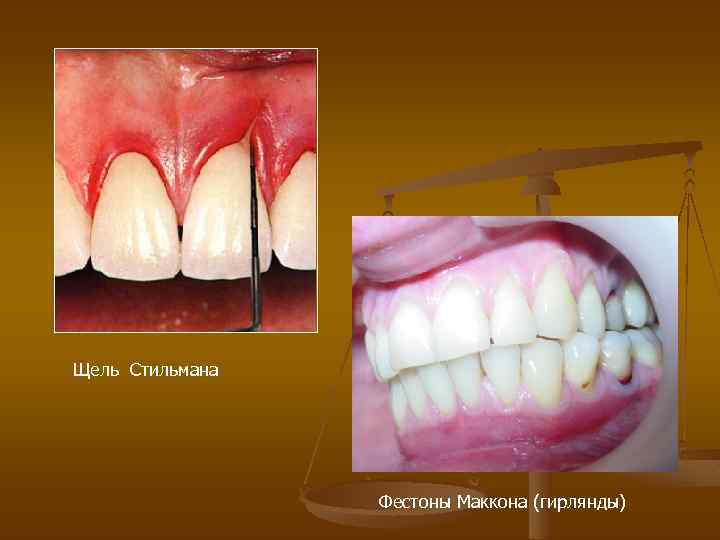 Щель Стильмана Фестоны Маккона (гирлянды) 