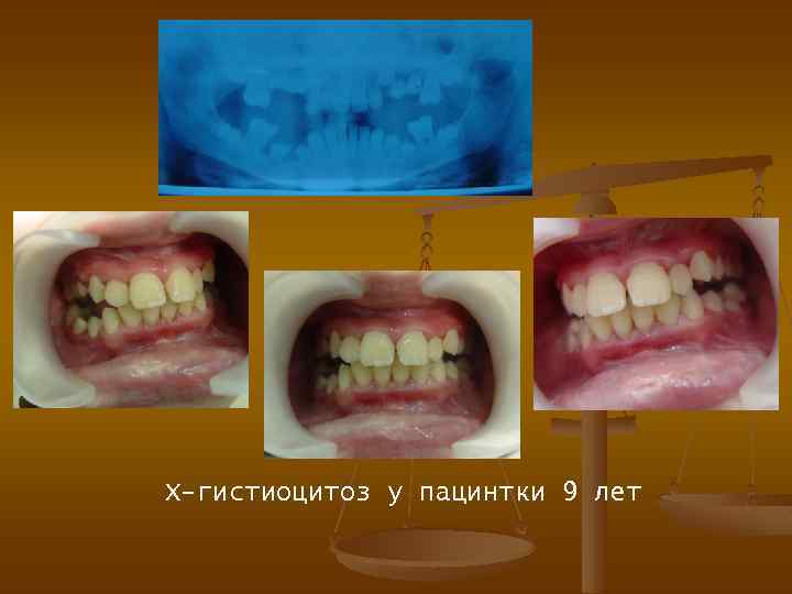 Х-гистиоцитоз у пацинтки 9 лет 