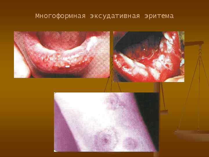Многоформная эксудативная эритема 