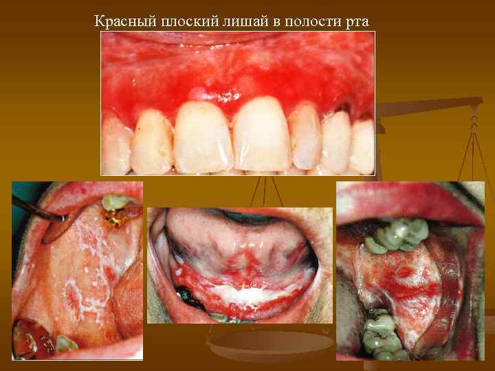 Красный плоский лишай в полости рта 