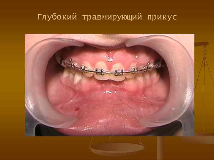 Глубокий травмирующий прикус 