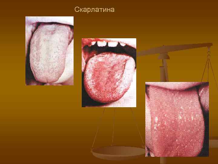 Скарлатина 