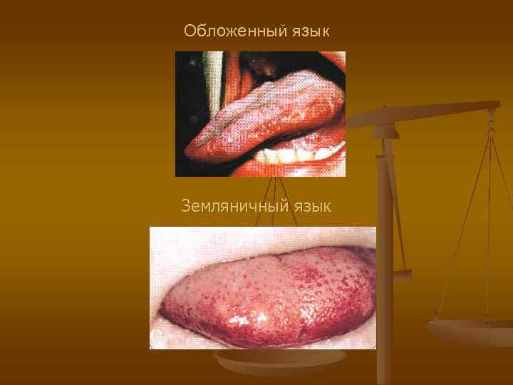 Обложенный язык Земляничный язык 