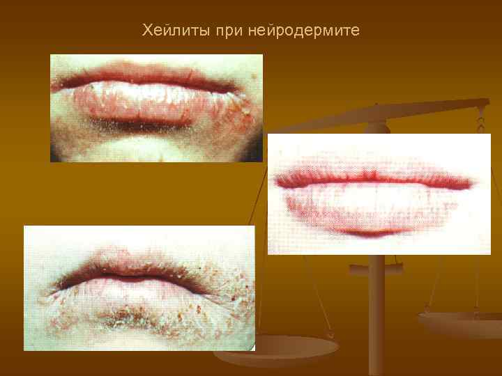 Хейлиты при нейродермите 