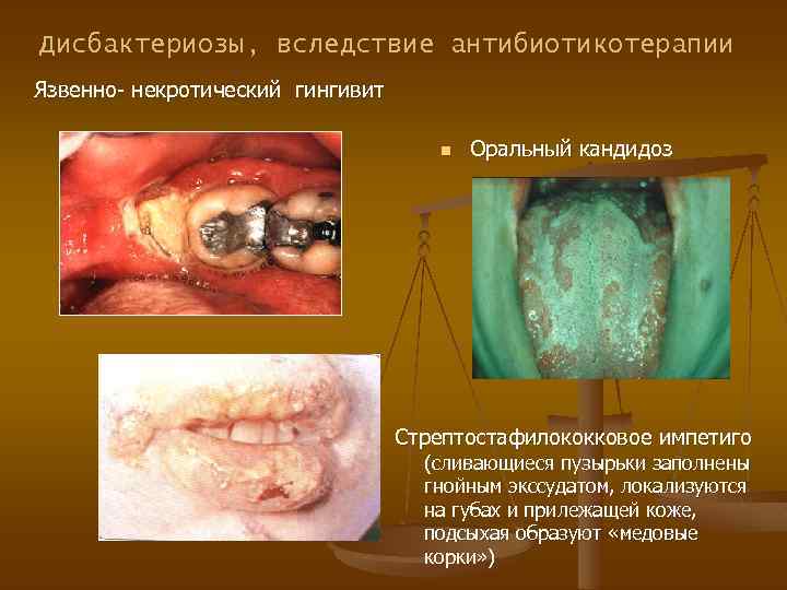 Дисбактериозы, вследствие антибиотикотерапии Язвенно- некротический гингивит n Оральный кандидоз Стрептостафилококковое импетиго (сливающиеся пузырьки заполнены