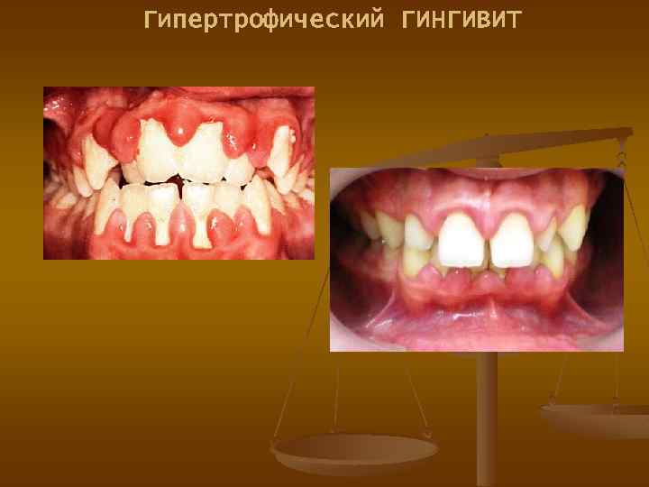 Гипертрофический ГИНГИВИТ 