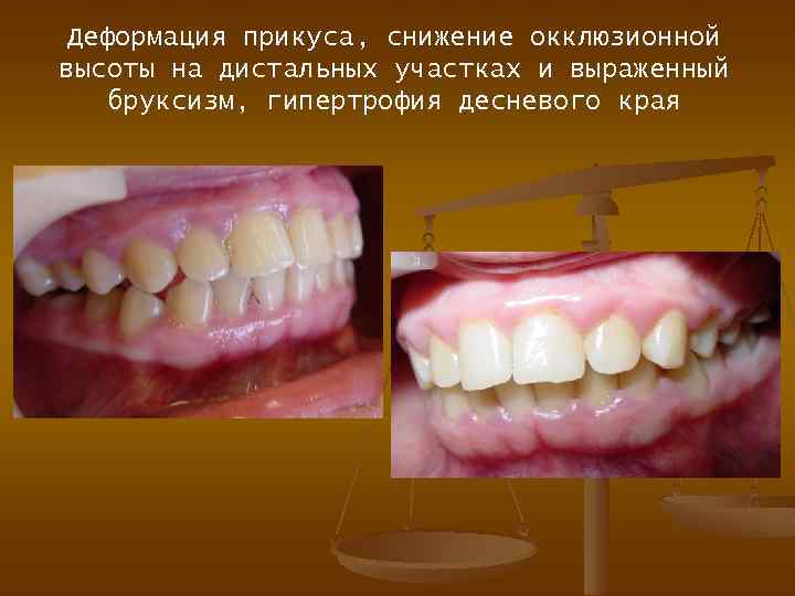 Деформация прикуса, снижение окклюзионной высоты на дистальных участках и выраженный бруксизм, гипертрофия десневого края