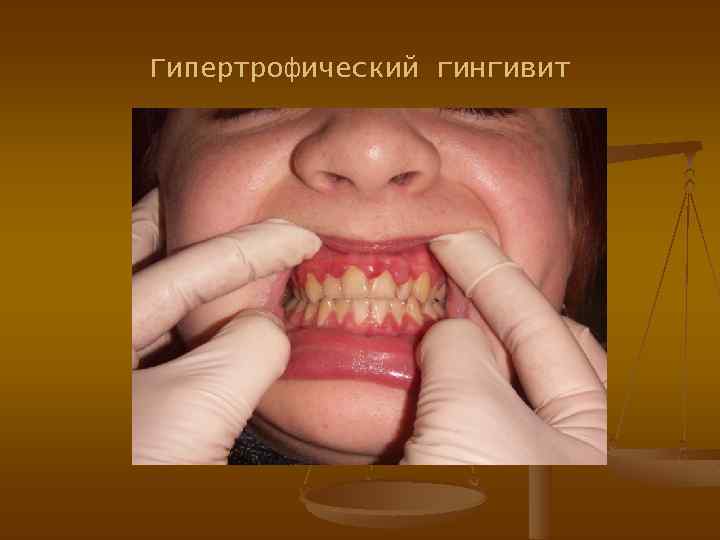 Гипертрофический гингивит 
