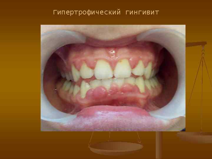 Гипертрофический гингивит 
