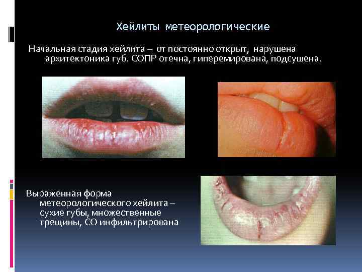 Хейлиты метеорологические Начальная стадия хейлита – от постоянно открыт, нарушена архитектоника губ. СОПР отечна,