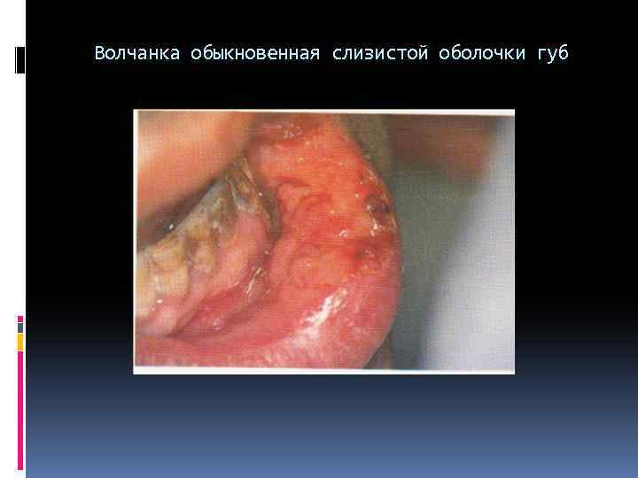 Волчанка обыкновенная слизистой оболочки губ 