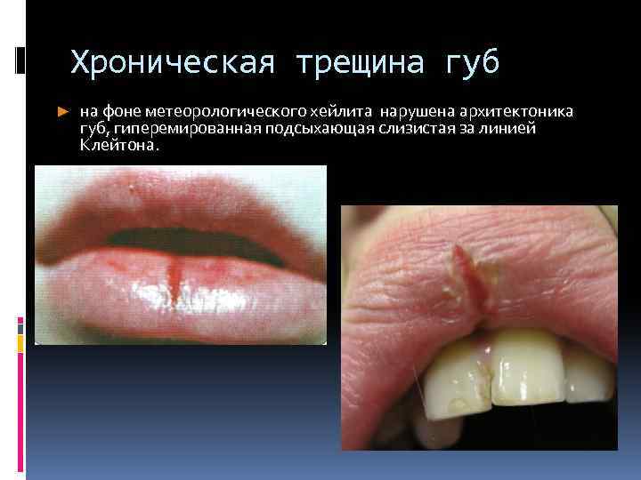 Хроническая трещина губ ► на фоне метеорологического хейлита нарушена архитектоника губ, гиперемированная подсыхающая слизистая