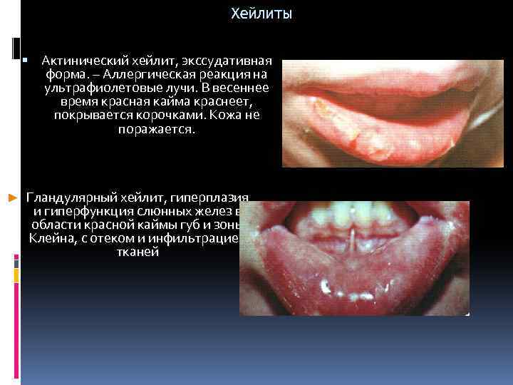 Хейлиты Актинический хейлит, экссудативная форма. – Аллергическая реакция на ультрафиолетовые лучи. В весеннее время