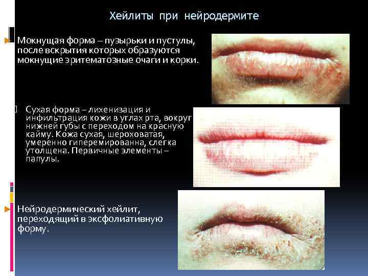 Хейлиты при нейродермите ► Мокнущая форма – пузырьки и пустулы, после вскрытия которых образуются