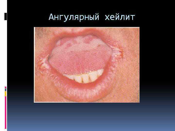 Ангулярный хейлит 