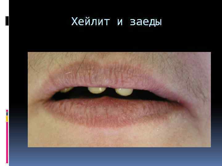 Хейлит и заеды 