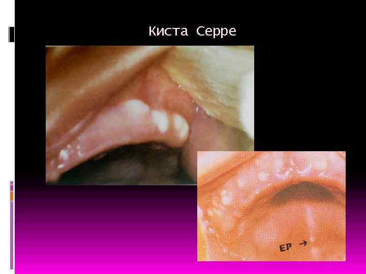 Киста Серре 