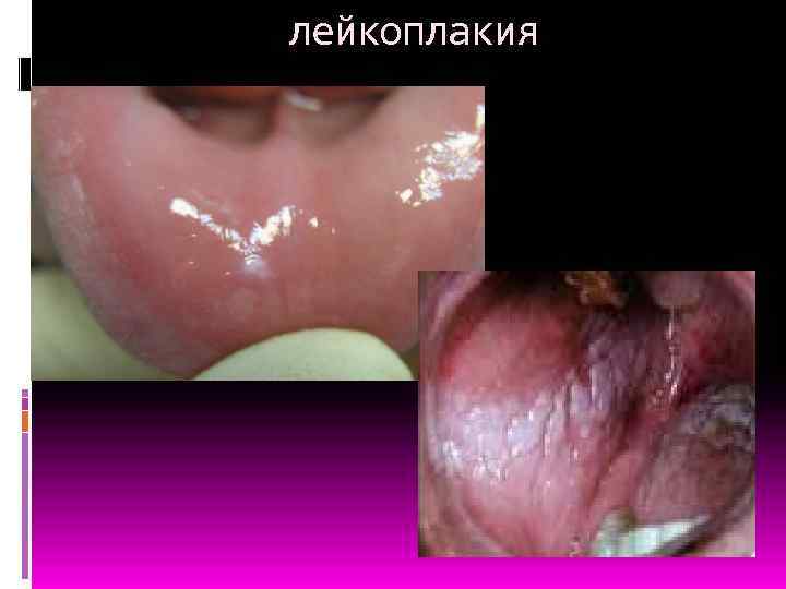 лейкоплакия 