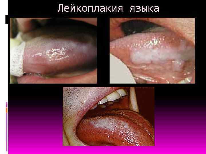 Лейкоплакия языка 