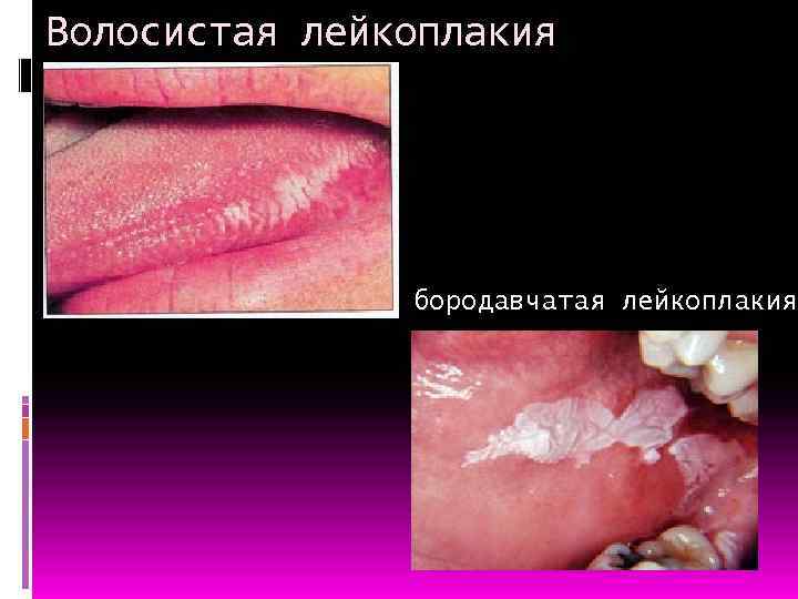 Волосистая лейкоплакия бородавчатая лейкоплакия 